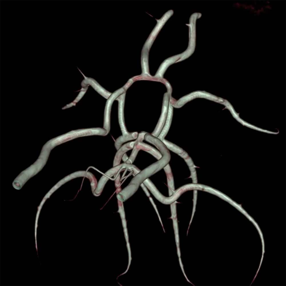 A distinctive RSD Circle of Willis vascular phantom